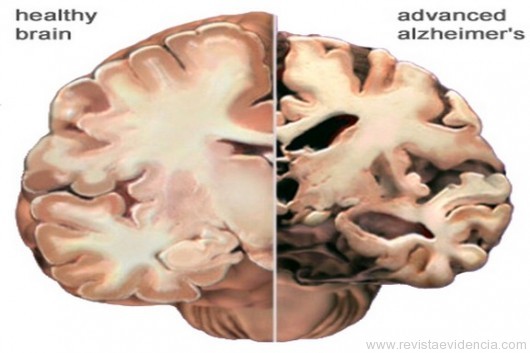 Alzheimer: um mal silencioso que adoece toda a família